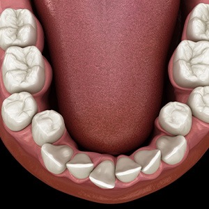 Illustration of crooked teeth