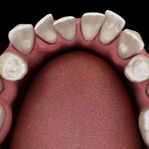 Illustration of gapped teeth