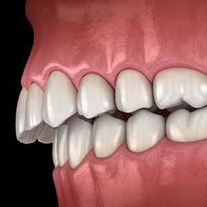 Illustration of an overbite