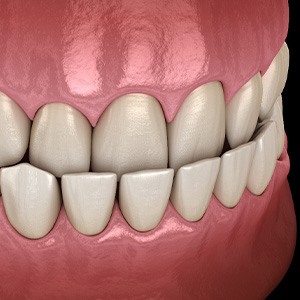 Illustration of an underbite