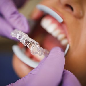 Dentist placing clear aligner on patient