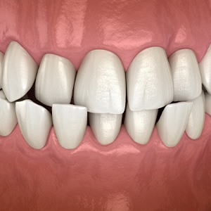Illustration of a crossbite