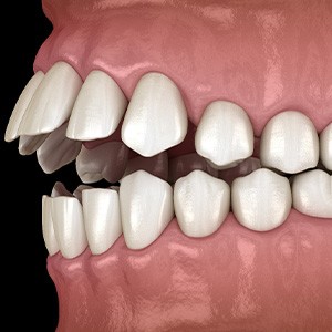 Illustration of an open bite