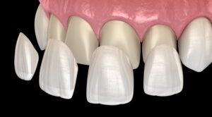 illustration of several veneers being put on teeth